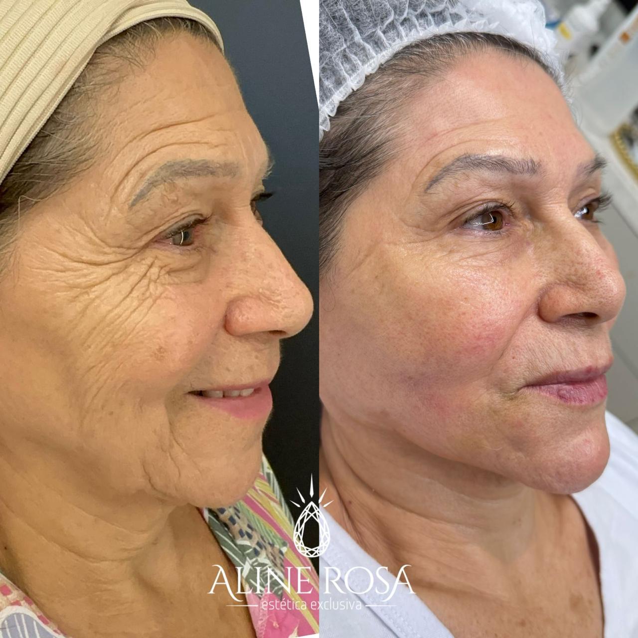 Estruturação Facial com Fios Coreanos